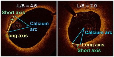 Superficial Calcification With Rotund Shape Is Associated With Carotid Plaque Rupture: An Optical Coherence Tomography Study